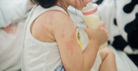 Estudo avalia microbioma da criança com alergia ao leite, ovo e amendoim