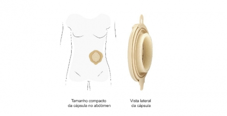 Cápsula inovadora devolve qualidade de vida a pessoas ostomizadas