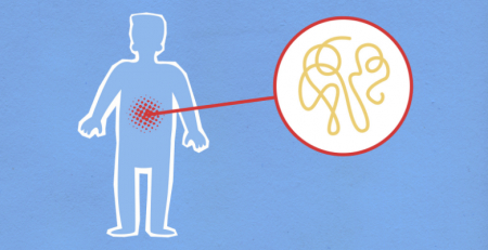 “Discriminação” no acesso a terapêuticas comparticipadas para a doença inflamatória do intestino